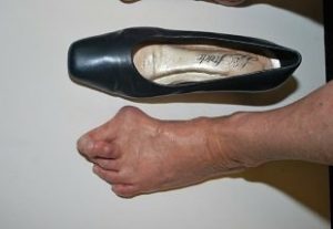 Us orthotic center top quality insoles for bunions orthotics and orthotic insoles to ease bunions