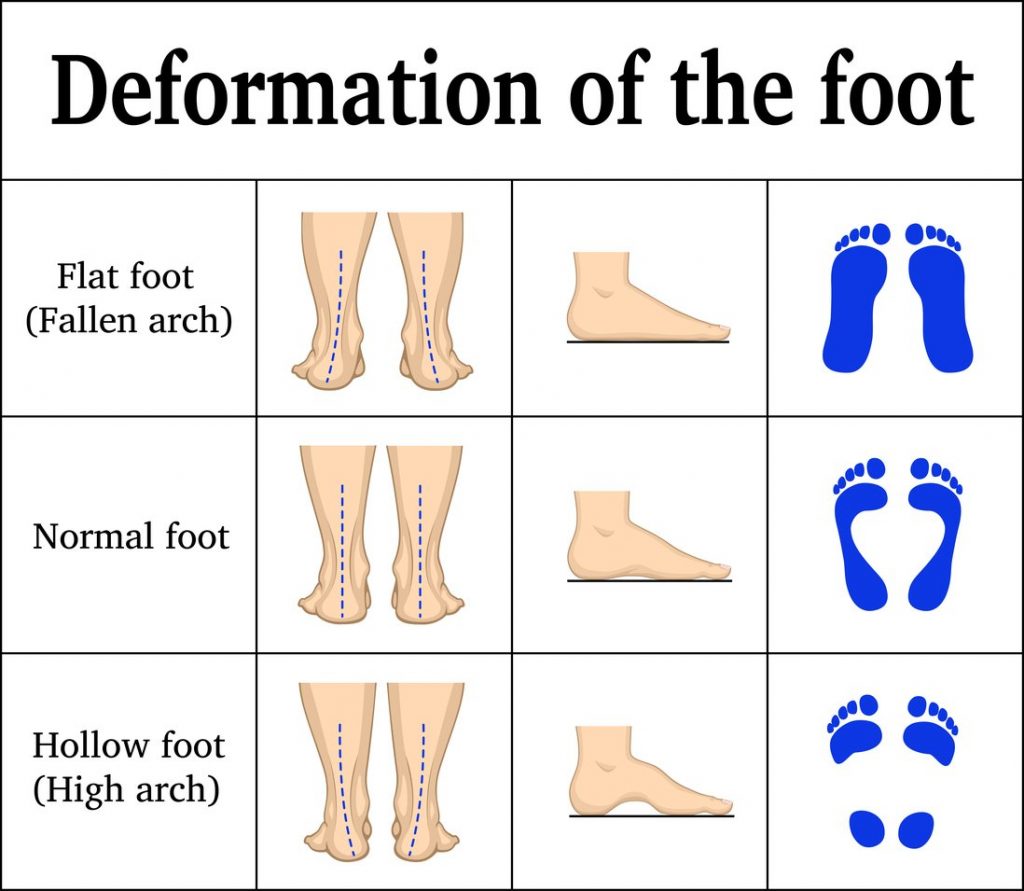 Us orthotic center custom insoles for flat feet