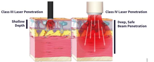 Use a custom orthotic with laser therapy for nail fungus